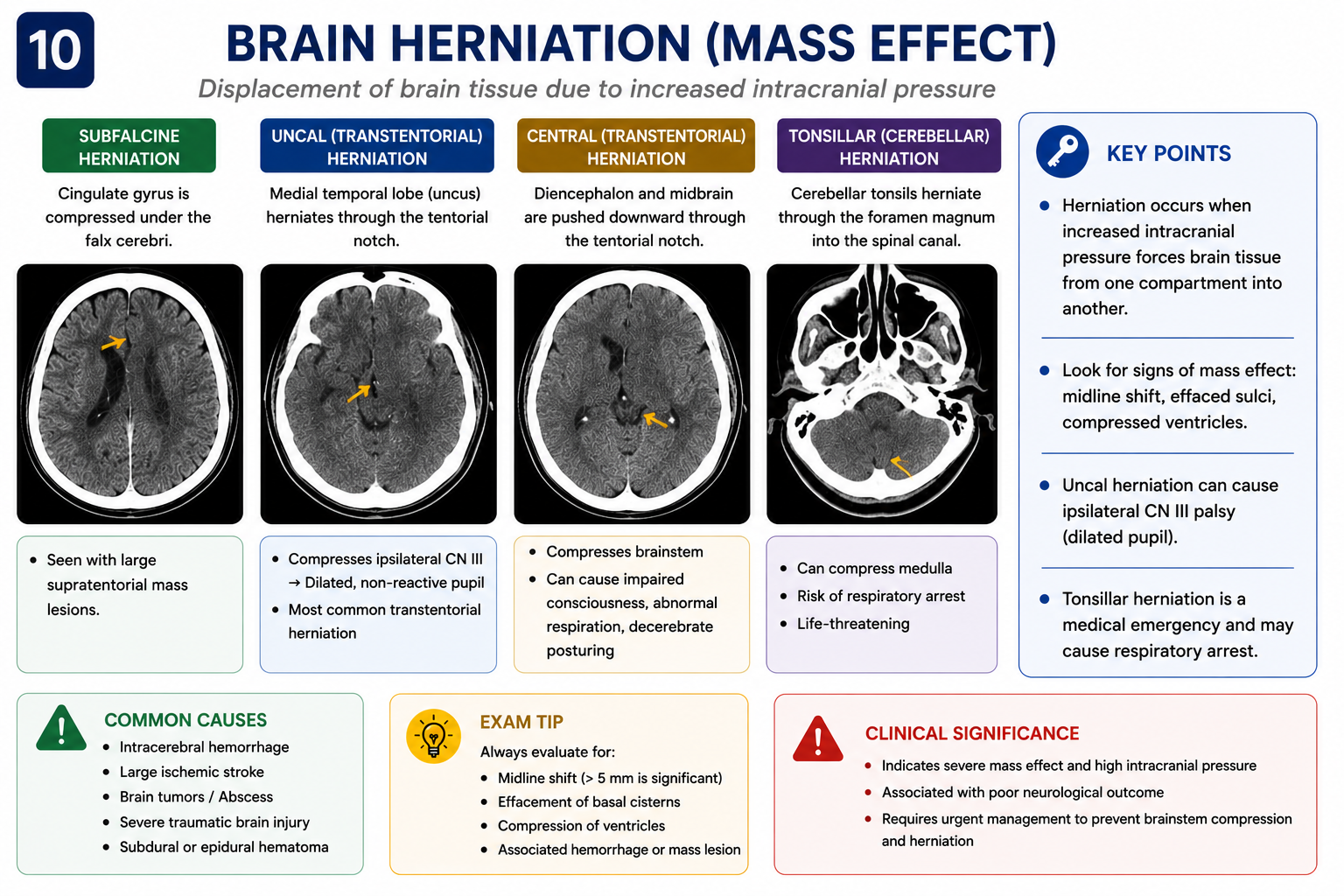 Mass effect and midline shift on CT